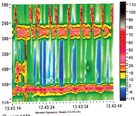 Oesophageal manometry showing the failure of the lower oesophageal sphincter (LES) to relax, elevated basal lower oesophageal sphincter pressure (51.6 mm of Hg) and aperistalsis of the oesophageal body suggestive of achalasia cardia-type 1.